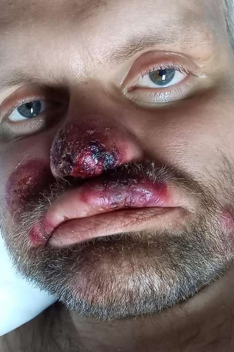 Var settur á samheitalyf, steyptist út í sárum og lést