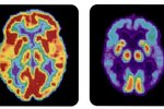 Straumhvörf í stríðinu gegn Alzheimer