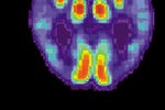 Ný nálgun í glímunni við Alzheimer?