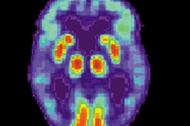 Alzheimer: Straumhvörf og  nýjar stefnur í rannsóknum